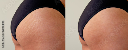 Image compare before and after Woman buttocks with stretch marks removal treatment, real people photo