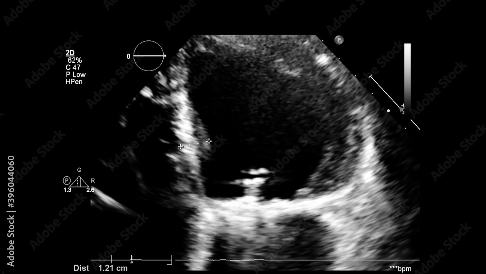 Obraz premium Image of the heart in gray-scale mode during transesophageal ultrasound.
