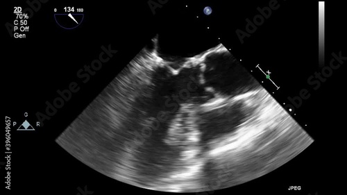 Transesophageal ultrasound video in gray-scale mode.