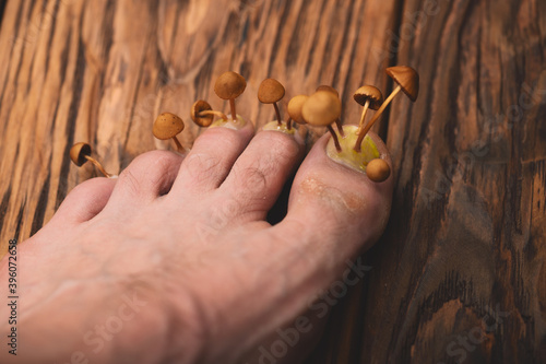 Foot with mushrooms on the nail plate on a wooden background. Concept of fungal diseases of the nails and skin of the feet, medicine dermatovenerology, top view close-up