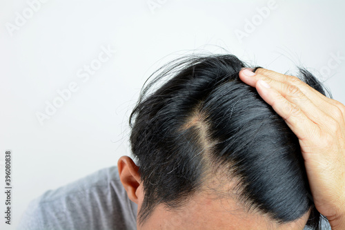 Hair loss everyday, serious problem of daily life.