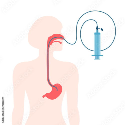Gastrointestinal system infographics of nasogastric feeding tube