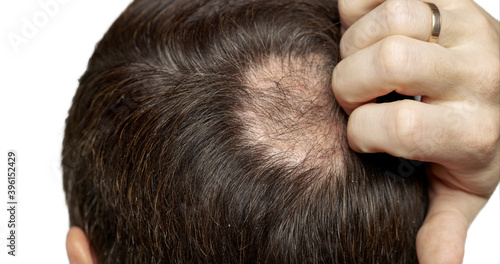 Man with hair loss problems closeup  isolated. Alopecia balding hairs on man scalp. Human alopecia or hair loss - person hand pointing his bald head. Scratching his head. Baldness. Depression  stress