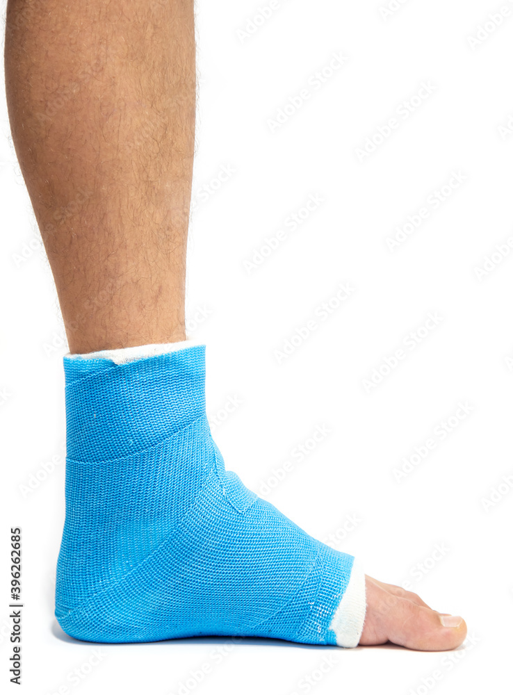Close up photos of foot blue splint for treatment of injuries from ankle sprain.