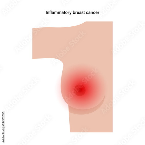 Breast disease concept