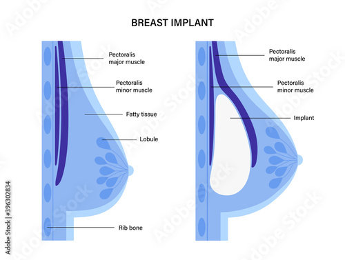 Breast Implant Concept