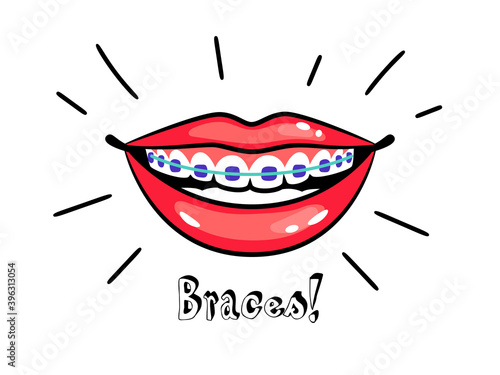 Orthodontic braces. Cartoon smile with dental braces, correct bite of teeth, vector illustration of medical orthodontic align and treatment for teeth in mouth