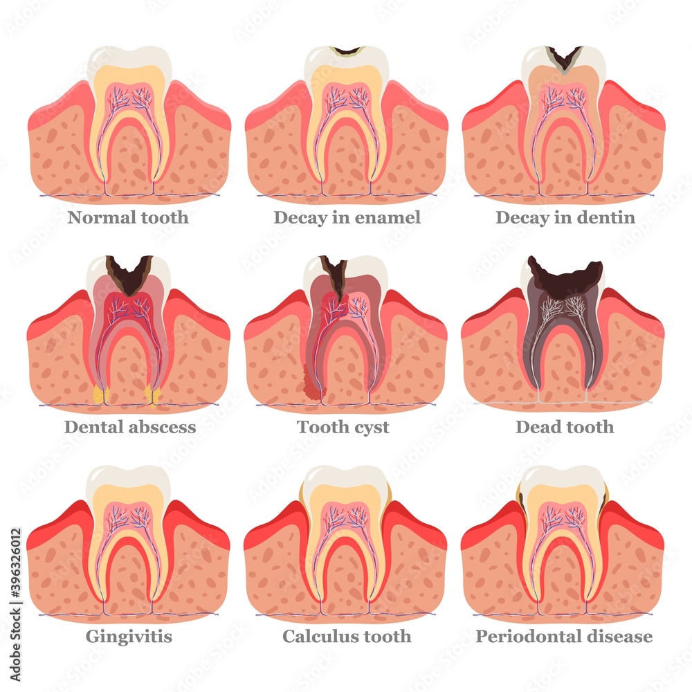 Tooth disorders set, flat vector illustration. Healthy and unhealthy teeth. Dental problems and