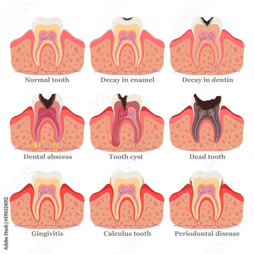 Tooth disorders set, flat vector illustration. Healthy and unhealthy teeth. Dental problems and diseases. Abscess, gingivitis, decay in enamel, decay in dentin, dead tooth, cyst, periodontal disease.