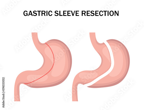 Gastric sleeve resection infographic. Stomach reduction surgery for weight loss. Medicine concept. Vector illustration