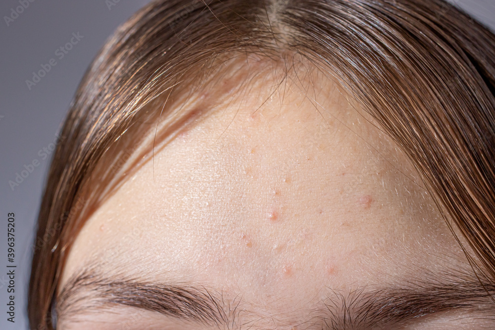 Acne on the forehead of a teenage girl - skin problems in children, acne treatment in dermatology. Acne on the forehead of a teenage girl - skin problems in children, acne treatment in dermatology.