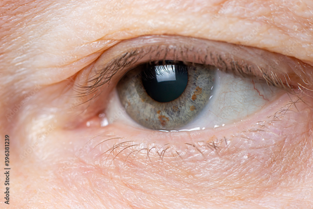 Macro photo of the human eye - overhanging upper eyelid, omitted eyelid ptosis, tired look of the old man, insomnia.