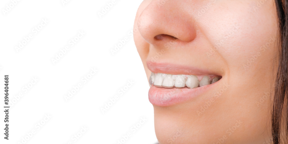 Obraz premium A side view of a womans smile in transparent and removable aligners with copy space.
