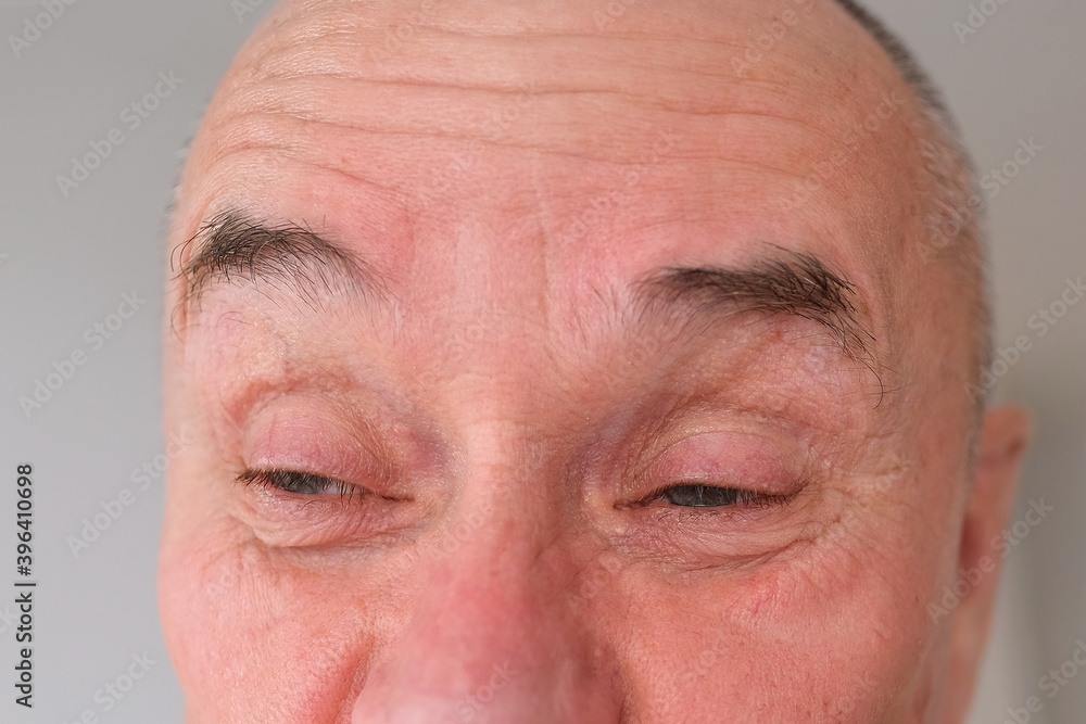 eyes, forehead of elderly man close-up, concept of restoration of human vision, health of optic nerve, nervous tic, myopia, hyperopia, vision test, anti-aging procedures, human emotions eyes, forehead of elderly man close-up, concept of restoration of human vision, health of optic nerve, nervous tic, myopia, hyperopia, vision test, anti-aging procedures, human emotions