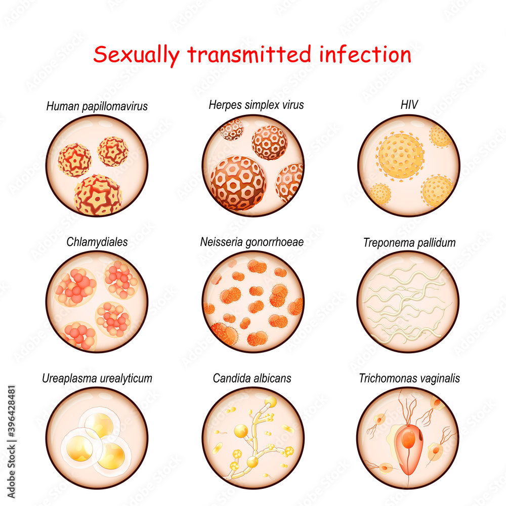 Sexually transmitted infection. Close-up of causative agents of Venereal disease Sexually transmitted infection. Close-up of causative agents of Venereal disease