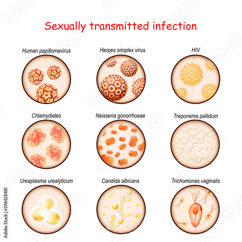 Sexually transmitted infection. Close-up of causative agents of Venereal disease photo