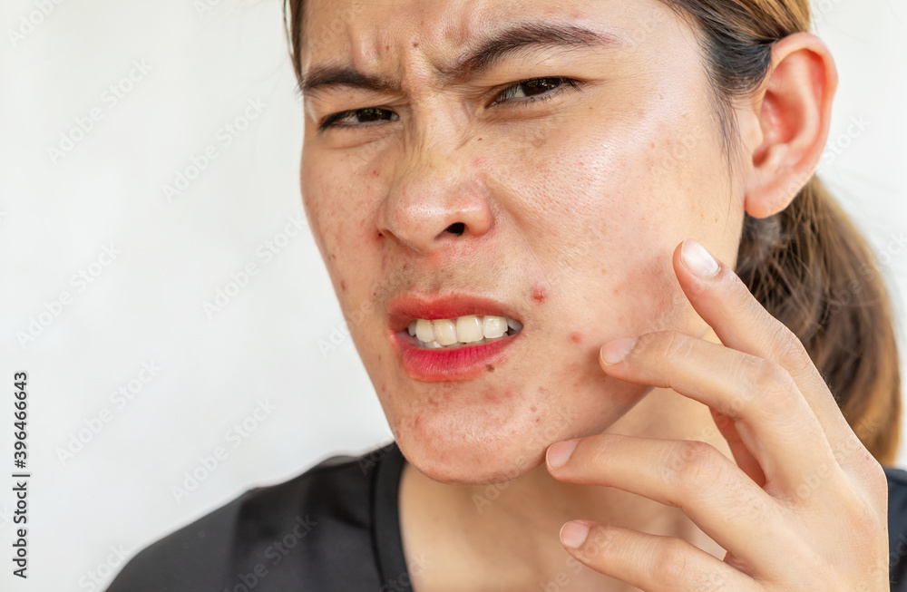 Obraz premium Asian woman having painful from acne inflamed on her face. Inflamed acne consists of swelling, redness, and pores that are deeply clogged with bacteria, oil, and dead skin cells.
