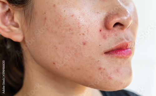 Cropped shot of woman having problems of acne inflamed on her face. Inflamed acne consists of swelling, redness, and pores that are deeply clogged with bacteria, oil, and dead skin cells.