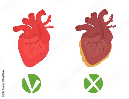 Healthy heart and unhealthy heart fatty infographics. Human organ, medicine concept. Vector illustration