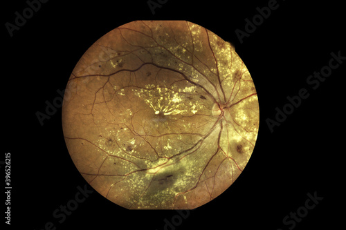 Konstfotografi View inside human eye disorders showing retina, optic nerve and macula Severe ag