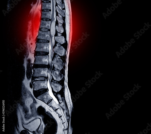 Foto MRI scan of lumbar spines of a patient finding Spinal mass at Lt