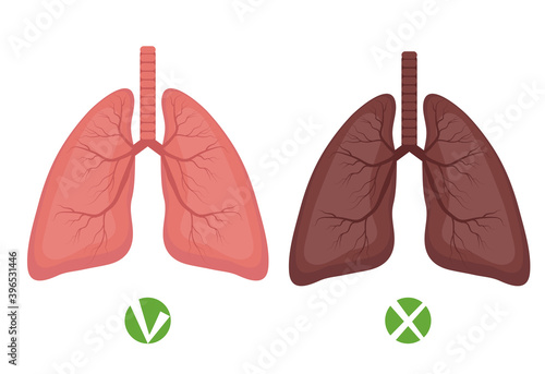 Healthy lungs and lungs disease or smoker infographics Isolated on white background. Vector illustration