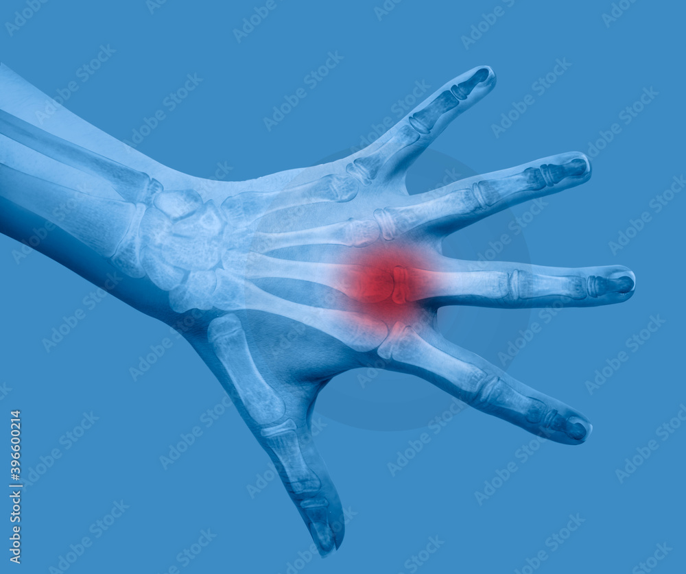 Fototapeta premium X-ray image of human hand