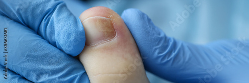 Doctor's hands in rubber gloves touch injured toenail in clinic closeup. Diagnosis and treatment of mycosis of feet concept. photo