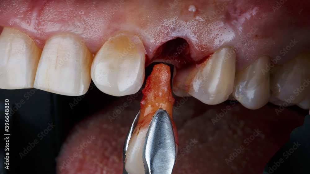 creative photo of tooth extraction with root before implantation Stock ...