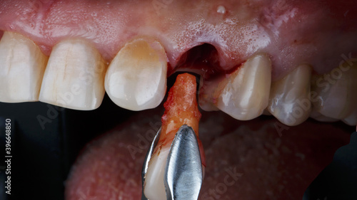 creative photo of tooth extraction with root before implantation photo