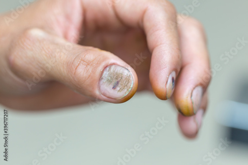 Close-up of a hand cutting man. Dry, cracked skin. Wounds and cracks in the fingers. Skin disease. Lightly injured. Hand skin care. Dermatology and treatment concept