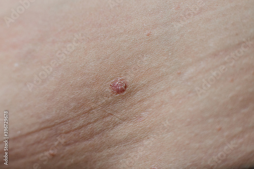 Psoriasis vulgaris skin. Psoriasis is an autoimmune disease that affects the skin cause skin inflammation red and scaly. Psoriasis and other skin diseases
