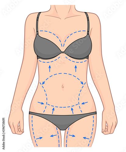 Body with dotted lines for plastic surgery and liposuction