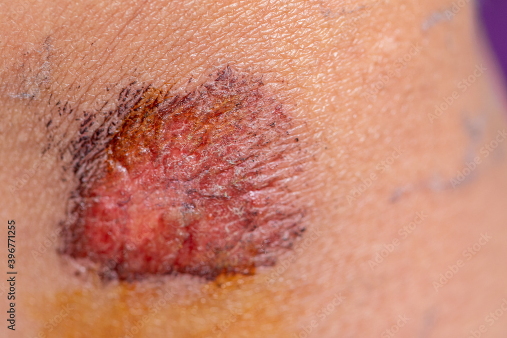 Fototapeta premium Closeup injured, Fresh wounds from accident. 