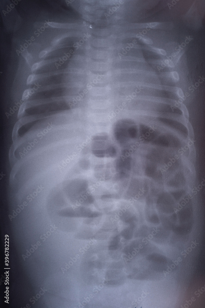intestinal obstruction in a child x ray Stock Photo Adobe Stock
