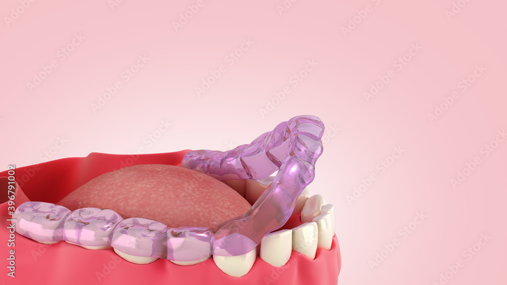 silicone braces on the display stand 3d render on color gradient silicone braces on the display stand 3d render on color gradient