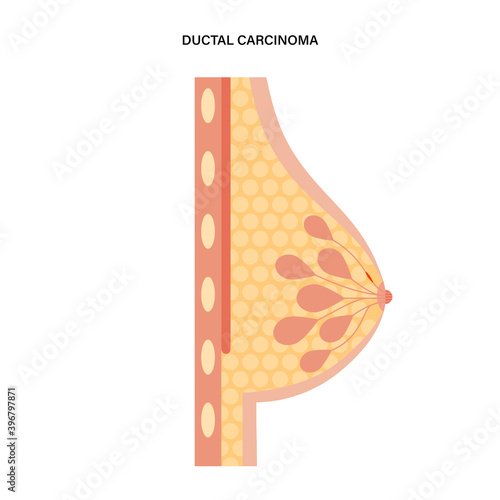 Breast disease concept