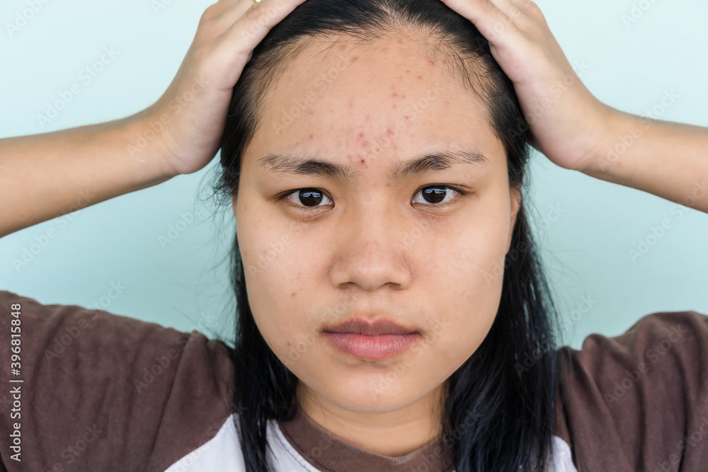 Close up of young Asian woman worry about her face when she has problems with skin on her face. Problems with acne and scar on the female skin. Problem skincare and health concept. Close up of young Asian woman worry about her face when she has problems with skin on her face. Problems with acne and scar on the female skin. Problem skincare and health concept.