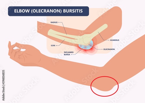 Hip pain knee heel cuff bone gout drug Feet bursa joint elbow treat tears drain shots fluid Ankle bursae tendon muscle trauma injury septic frozen tennis therapy rotator disease greater relieve