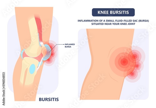Hip pain knee heel cuff bone gout drug Feet bursa joint elbow treat tears drain shots fluid Ankle bursae tendon muscle trauma injury septic frozen tennis therapy rotator disease greater relieve