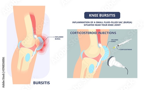 Hip pain knee heel cuff bone gout drug Feet bursa joint elbow treat tears drain shots fluid Ankle bursae tendon muscle trauma injury septic frozen tennis therapy rotator disease greater relieve