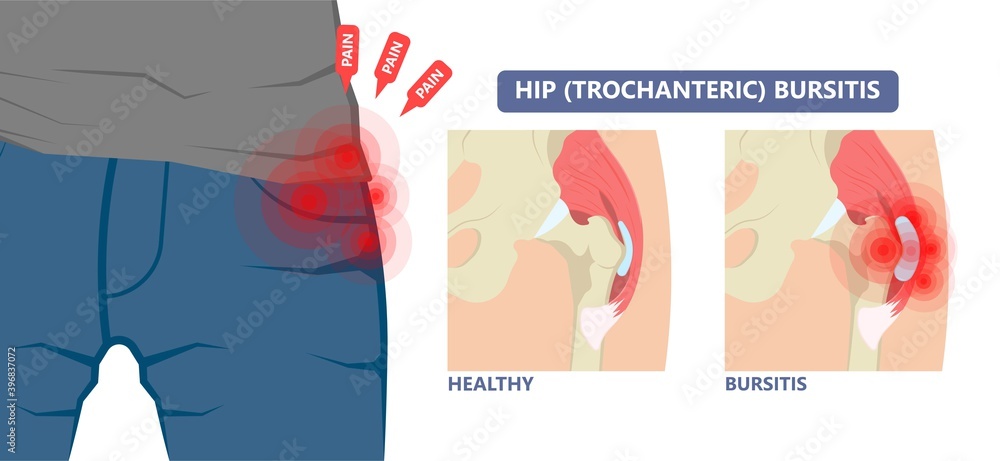 Hip pain knee heel cuff bone gout drug Feet bursa joint elbow treat tears drain shots fluid Ankle bursae tendon muscle trauma injury septic frozen tennis therapy rotator disease greater relieve Hip pain knee heel cuff bone gout drug Feet bursa joint elbow treat tears drain shots fluid Ankle bursae tendon muscle trauma injury septic frozen tennis therapy rotator disease greater relieve