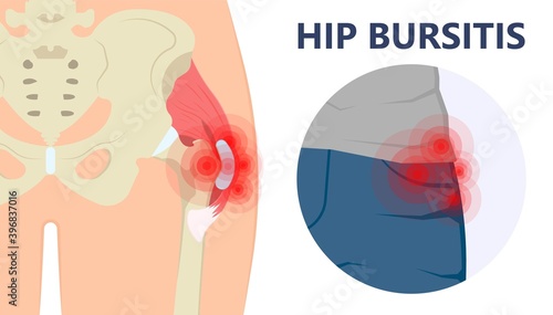Hip pain knee heel cuff bone gout drug Feet bursa joint elbow treat tears drain shots fluid Ankle bursae tendon muscle trauma injury septic frozen tennis therapy rotator disease greater relieve