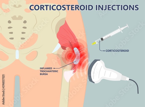 Hip pain knee heel cuff bone gout drug Feet bursa joint elbow treat tears drain shots fluid Ankle bursae tendon muscle trauma injury septic frozen tennis therapy rotator disease greater relieve