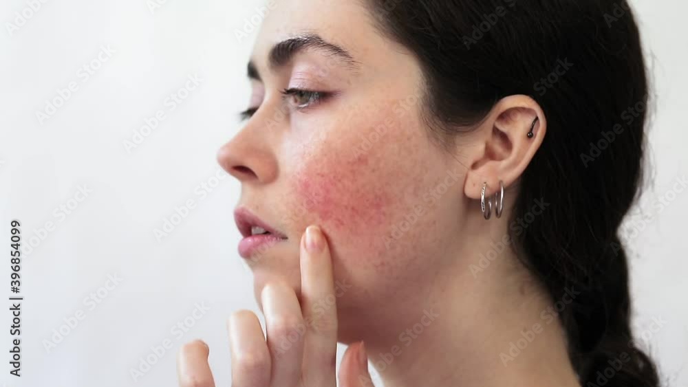 Close-up profile portrait of a young woman showing redness on her cheek. White background. The concept of rosacea and couperose Close-up profile portrait of a young woman showing redness on her cheek. White background. The concept of rosacea and couperose