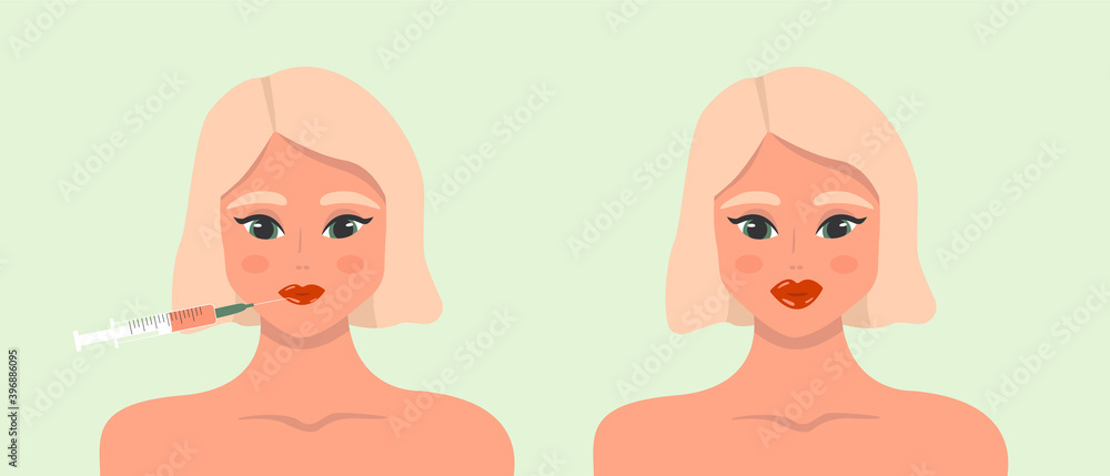 Beauty injection. Lip fillers, hyaluronic acid. Collection of girls in beauty industry. Cosmetic procedure and injection concept. Vector illustration. Beauty injection. Lip fillers, hyaluronic acid. Collection of girls in beauty industry. Cosmetic procedure and injection concept. Vector illustration.
