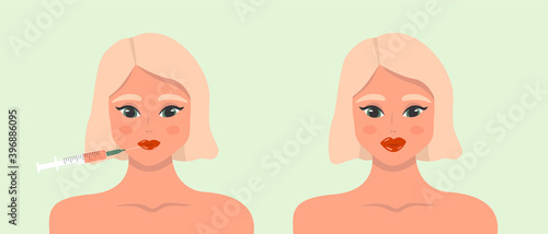 Beauty injection. Lip fillers, hyaluronic acid. Collection of girls in beauty industry. Cosmetic procedure and injection concept. Vector illustration.