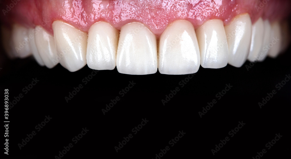 Obraz premium Full mouth teeth made of zircon arch ceramic crowns human teeth of upper veneers of teeth prothesis. Dental restoration treatment clinic patient. Implants on black background closeup surgery dentistry