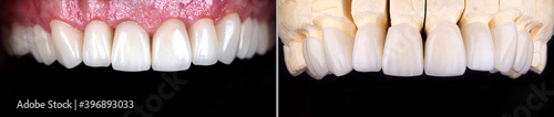 Perfect smile before and after bleaching procedure whitening of zircon arch ceramic prothesis Implants crowns. Dental restoration treatment clinic patient. Result of oral surgery dentistry,