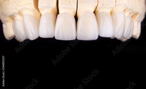 Canvastavla Full mouth teeth made of zircon arch ceramic crowns human teeth of upper veneers of teeth prothesis